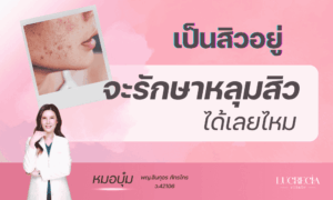 เป็นสิวอยู่ ทำเลเซอร์หลุมสิวได้เลยไหม