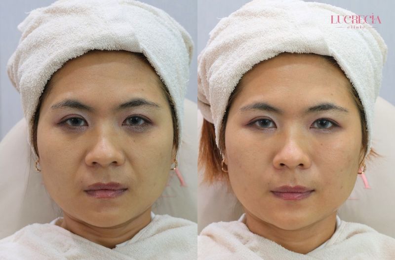 ฟิลเลอร์ร่องแก้ม lucrecia clinic