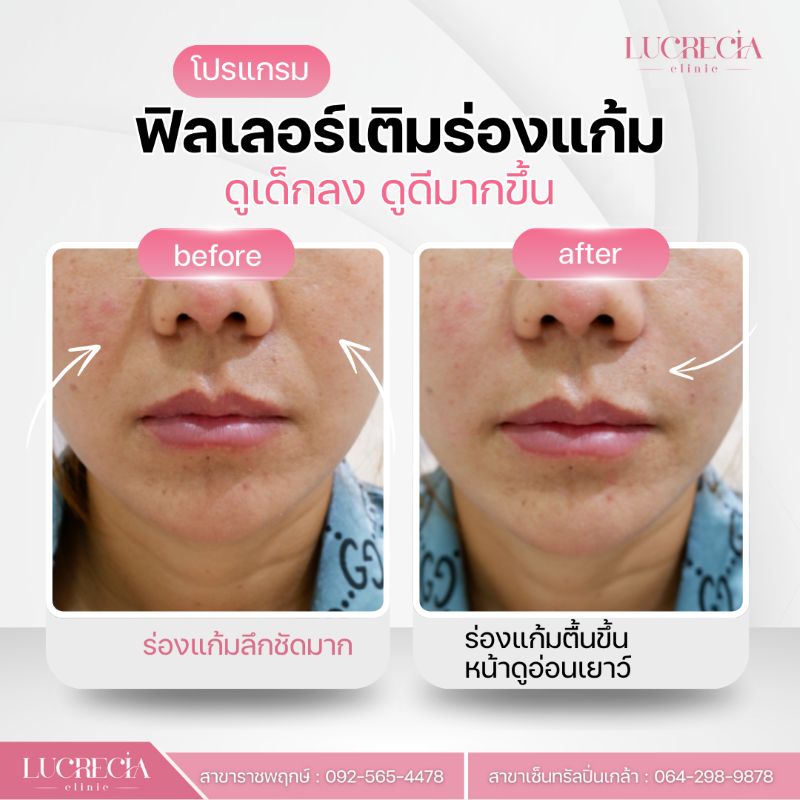ฟิลเลอร์ร่องแก้ม lucrecia clinic
