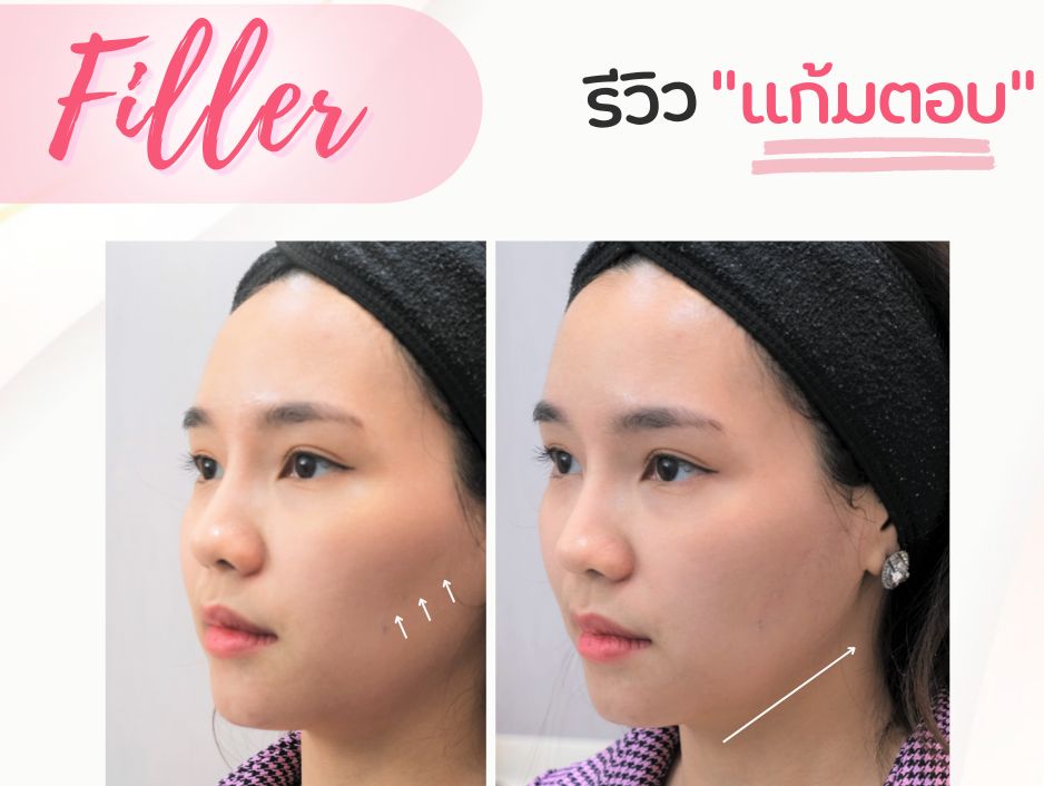 ฟิลเลอร์แก้มตอบ lucrecia clinic