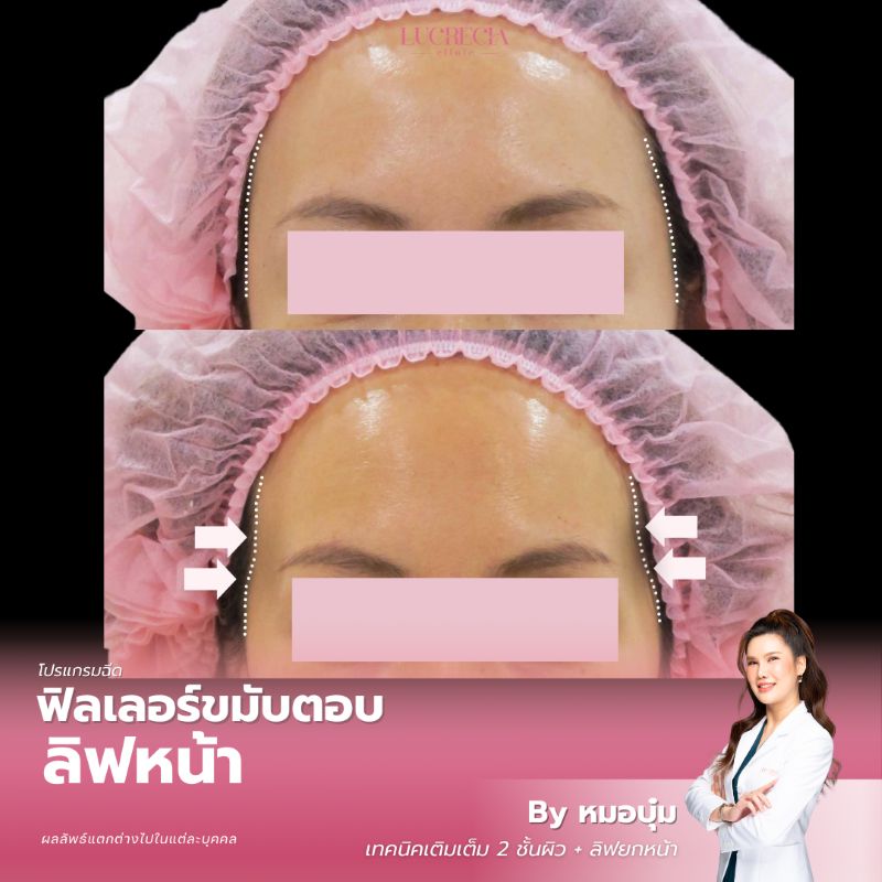 รีวิว ฟิลเลอร์ขมับ-100 lucrecia clinic