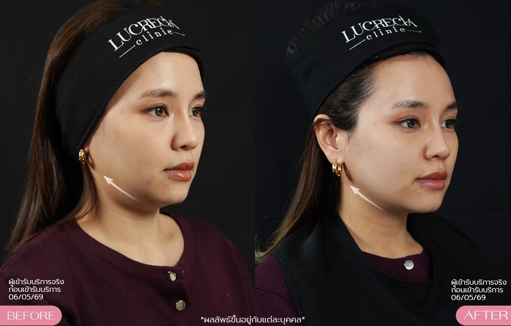 LUX กระชับหน้า รีวิว lucrecia clinic