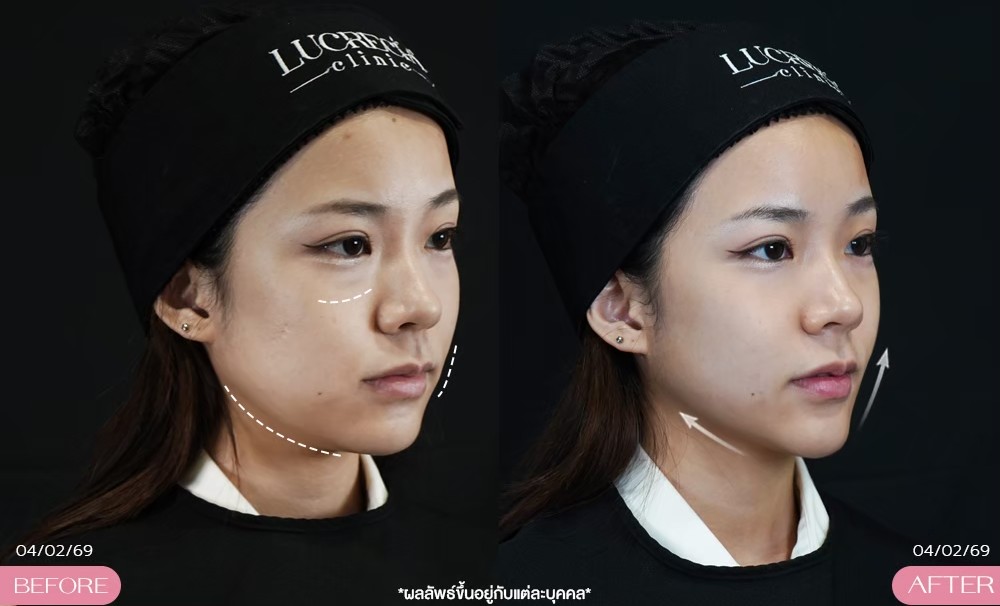 LUX กระชับหน้า รีวิว lucrecia clinic