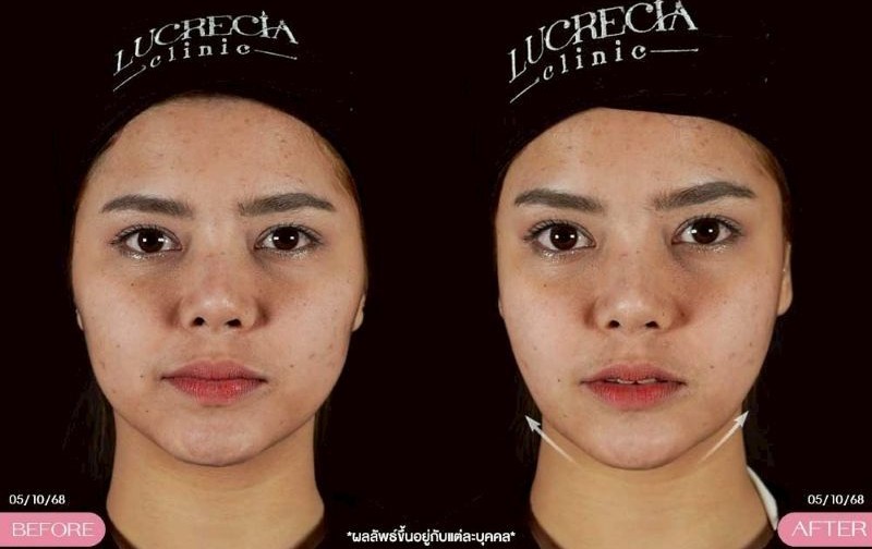 LUX กระชับหน้า รีวิว lucrecia clinic
