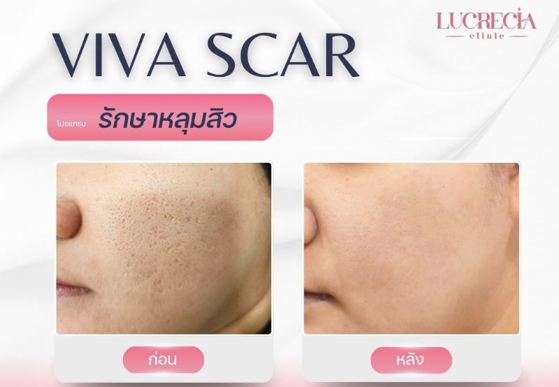 viva scar หลุมสิว