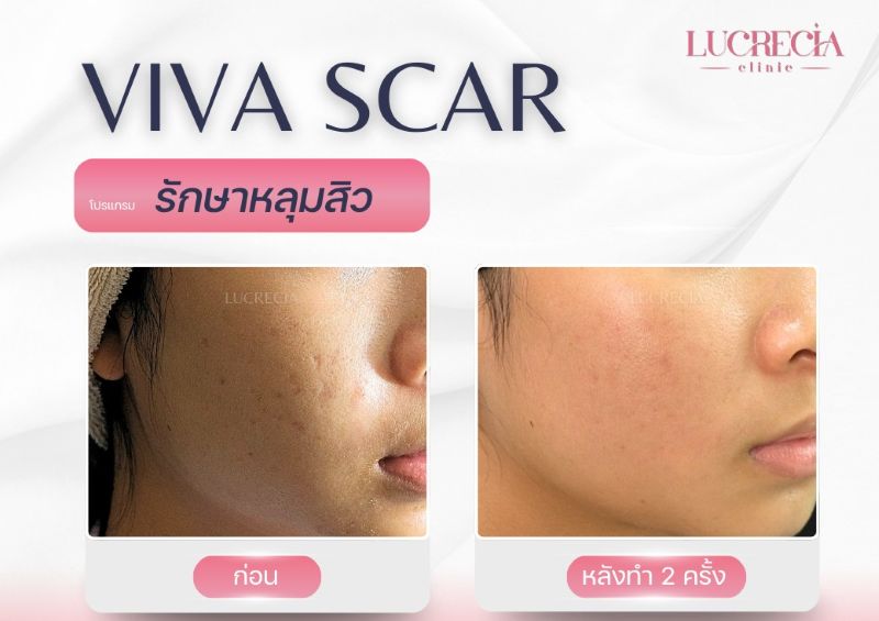 viva scar หลุมสิว
